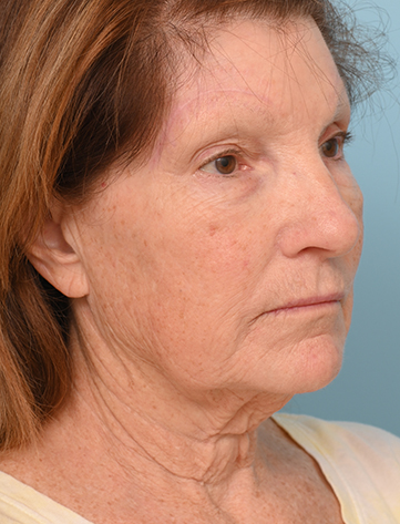 Face Lift/ Neck Lift