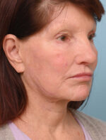 Face Lift/ Neck Lift