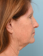 Face Lift/ Neck Lift