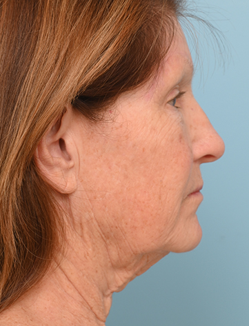 Face Lift/ Neck Lift