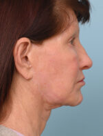 Face Lift/ Neck Lift