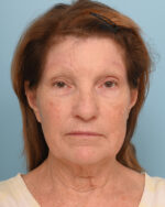 Facial Fat Transfer