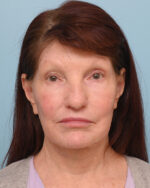 Facial Fat Transfer