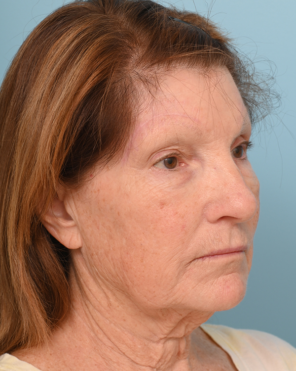 Facial Fat Transfer