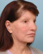 Facial Fat Transfer