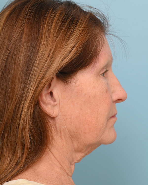 Facial Fat Transfer