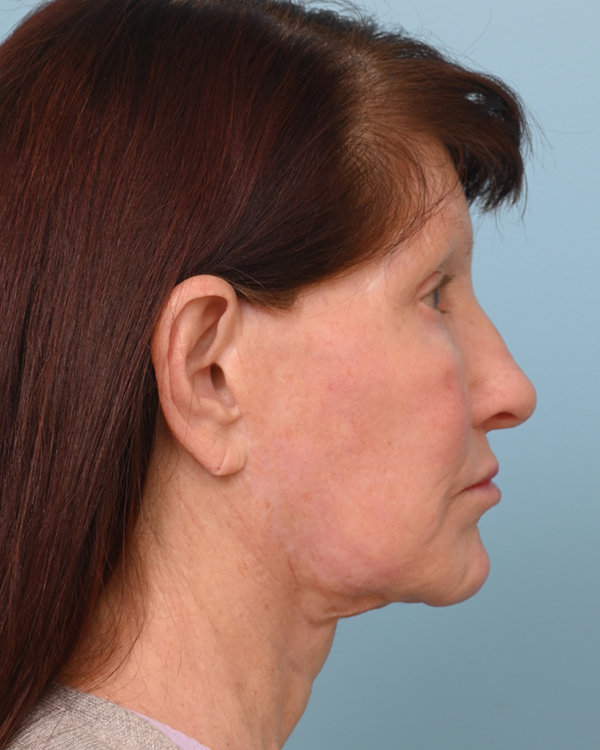 Facial Fat Transfer