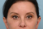 Eye Rejuvenation