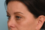 Eye Rejuvenation