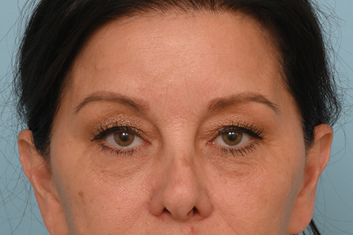 Eye Rejuvenation
