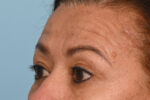 Brow Lift