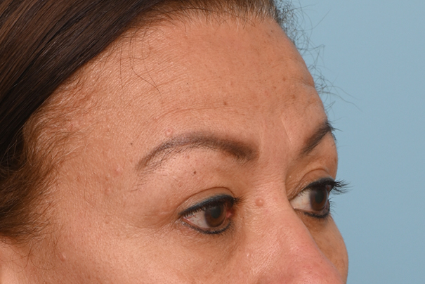 Brow Lift
