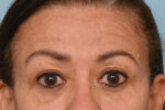 Brow Lift