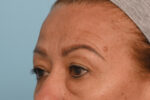 Brow Lift