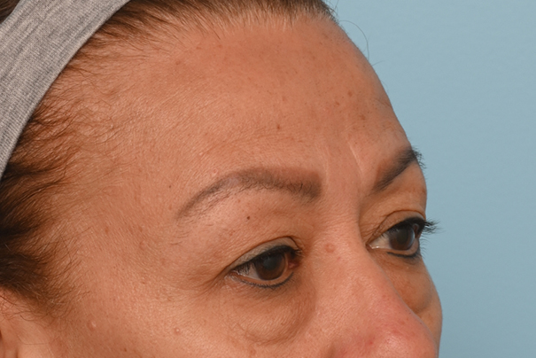 Brow Lift