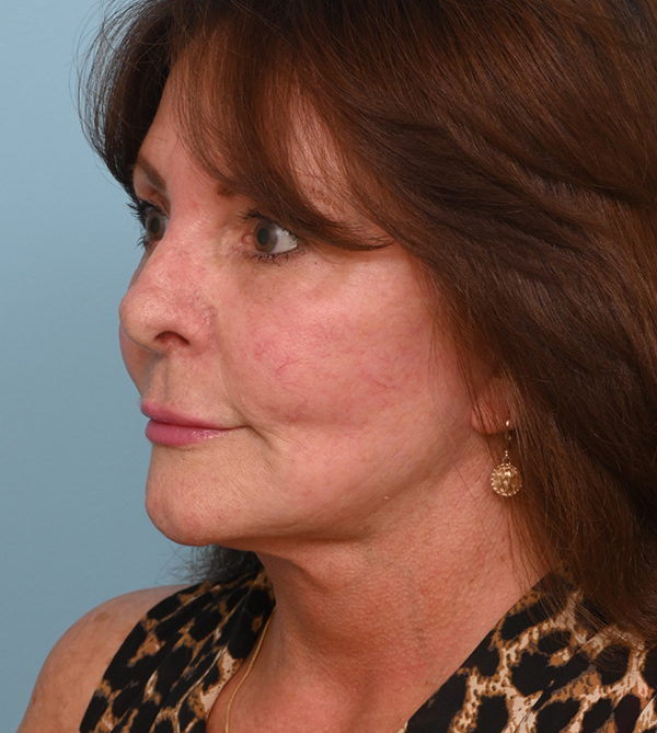 Face Lift/ Neck Lift