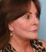 Face Lift/ Neck Lift