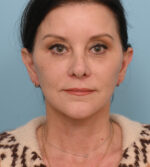 Face Lift/ Neck Lift
