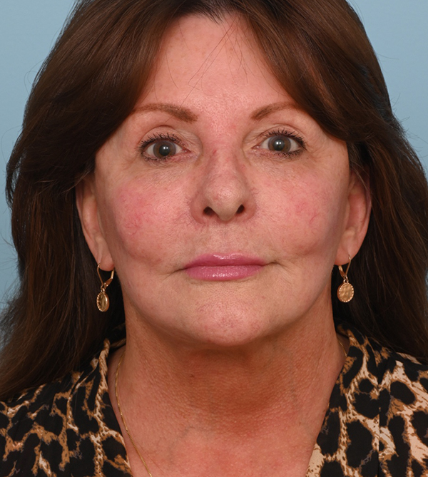 Face Lift/ Neck Lift