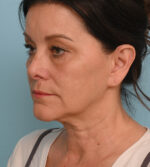 Face Lift/ Neck Lift