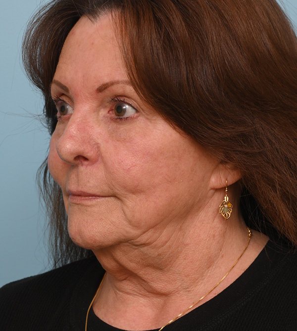 Face Lift/ Neck Lift