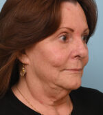 Face Lift/ Neck Lift