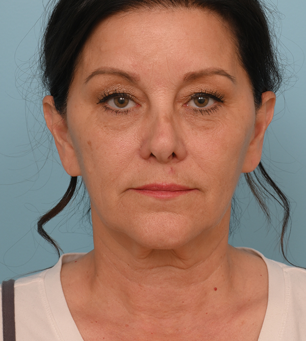 Face Lift/ Neck Lift