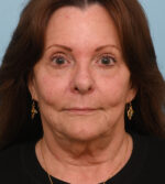 Face Lift/ Neck Lift