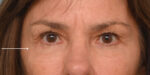 Facial Fat Transfer