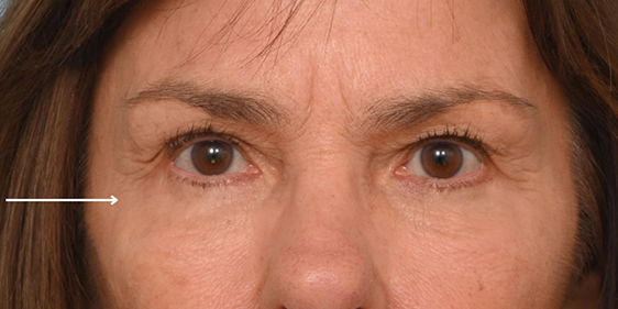 Facial Fat Transfer