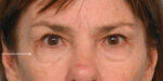 Facial Fat Transfer