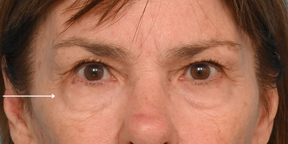 Facial Fat Transfer