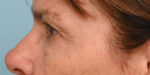 Facial Fat Transfer