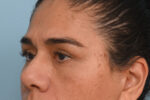 Eye Rejuvenation