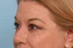Eye Rejuvenation