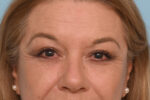 Eye Rejuvenation