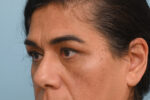 Eye Rejuvenation