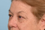 Eye Rejuvenation