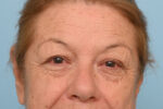 Eye Rejuvenation