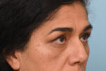 Eye Rejuvenation