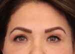 Brow Lift