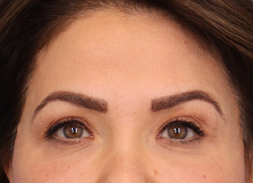 Brow Lift