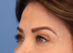 Brow Lift