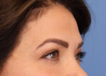 Brow Lift