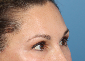 Brow Lift
