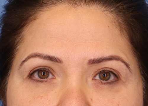 Brow Lift