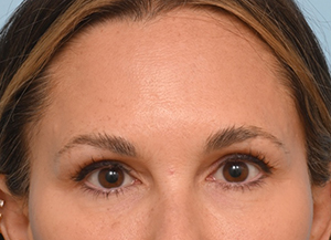 Brow Lift