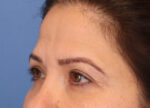 Brow Lift