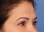 Brow Lift