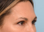 Brow Lift